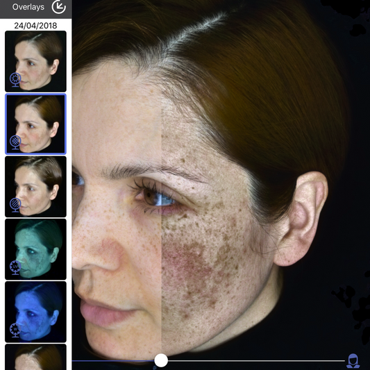 Skin Consultation and LED (75mins) $60 redeemable on products